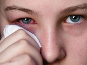Лечение воспаления глаз гидрокортизоновой мазью