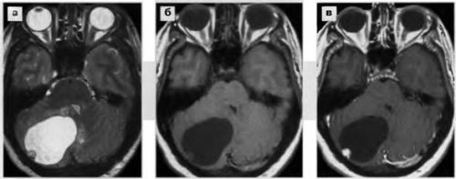 Опухоль мозга на снимке МРТ