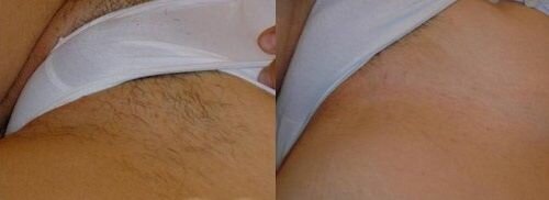 фото до и после эпиляции глубокого бикини