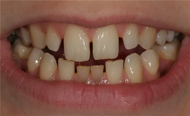 тремы между зубам у человека