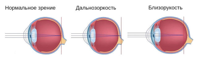 Форма глаза при нормальном зрении, дальнозоркости и близорукости