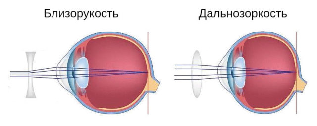 Коррекция зрения при помощи линз