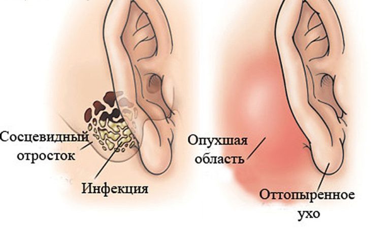 Болезнь уха