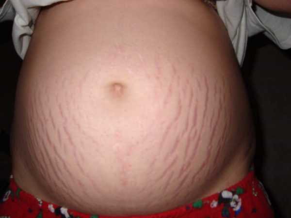 Рейтинг масел от растяжек при беременности